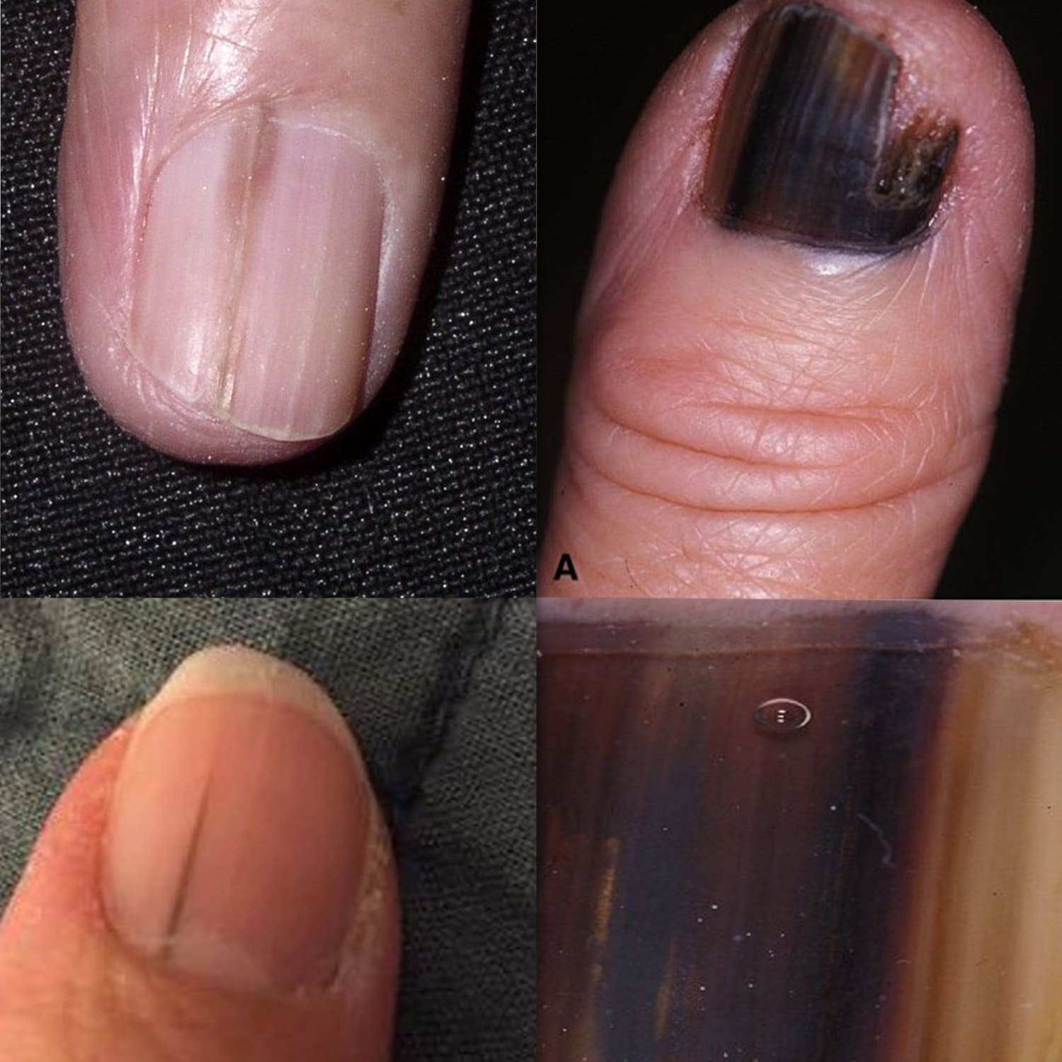 Common Nail Issues in Seniors