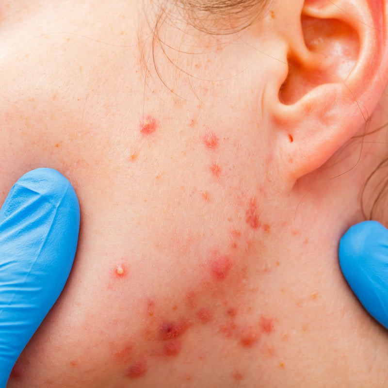 Opzioni di Trattamento per l'Acne Ormonale