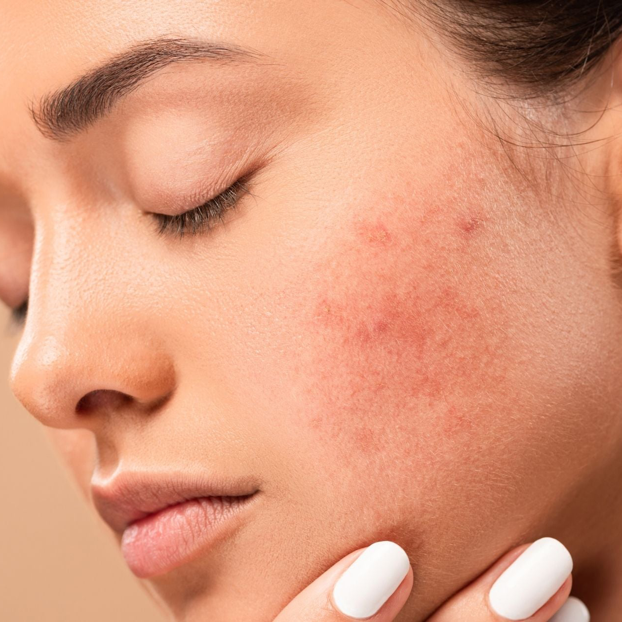 What Is Hormonal Acne?