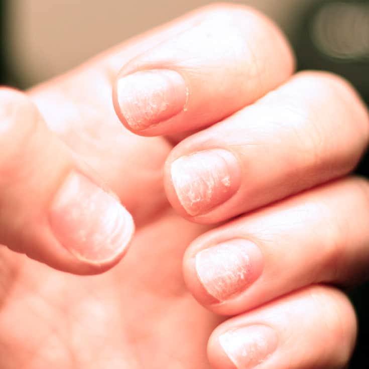 Brittle Nails