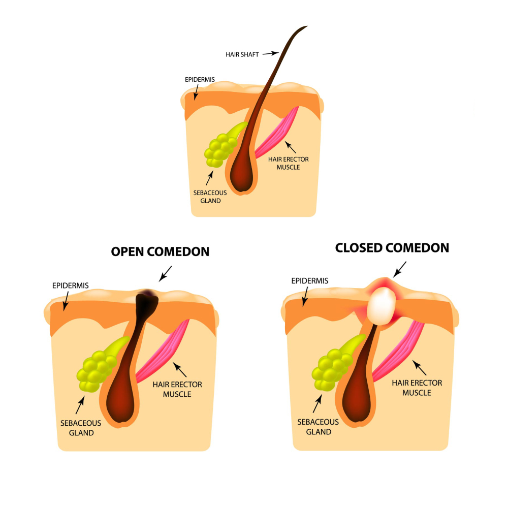 Comprendere l'Acne: Le Basi