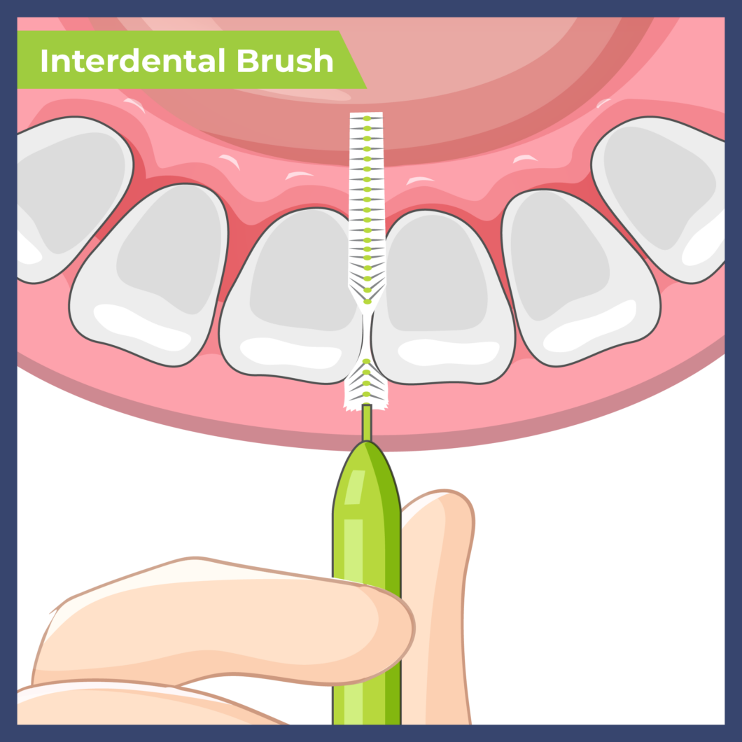 Come Usare le Spazzole Interdentali
