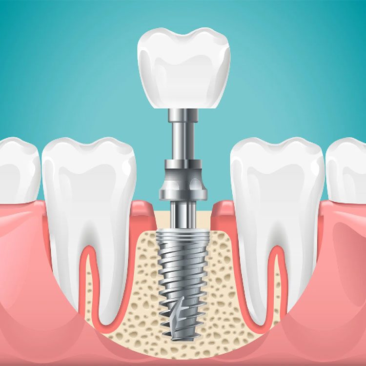 Comprendere i tuoi Impianti Dentali