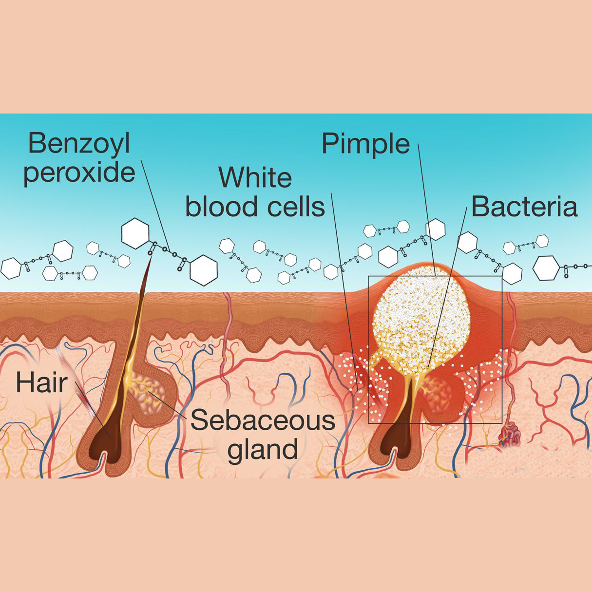 Understanding Benzoyl Peroxide