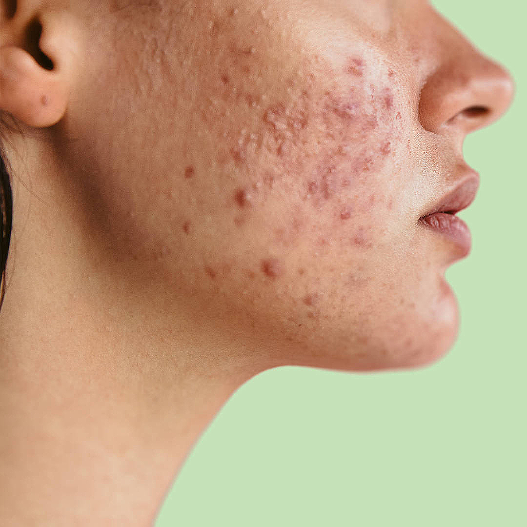 Causes of Hormonal Acne