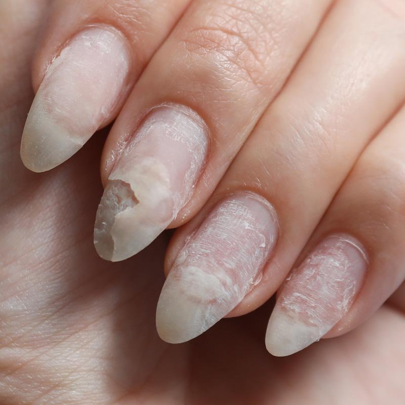 The Basics of Nail Fungus