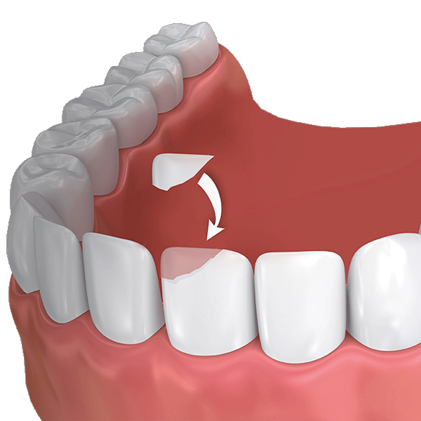 Il Processo del Bonding Dentale