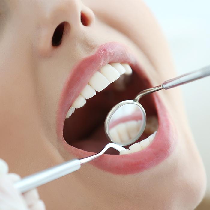 L'Importanza dei Controlli Dentali Regolari