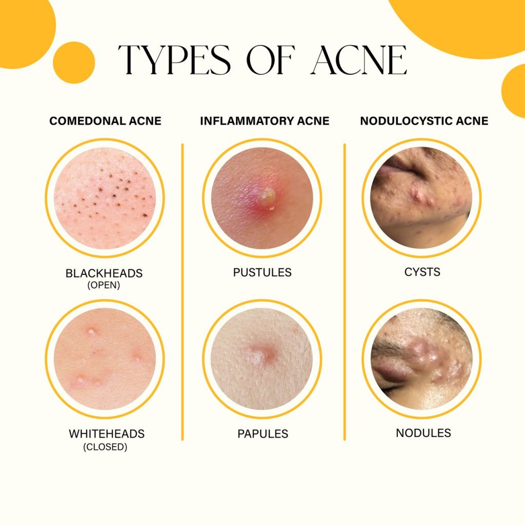 Comprendere i Tipi di Acne