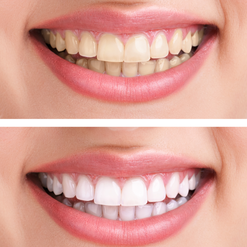 Preparing for Your Whitening Journey