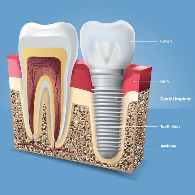 Cosa Sono gli Impianti Dentali?