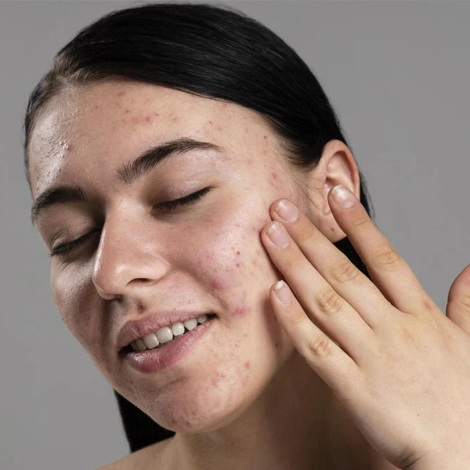 Understanding Acne and Its Causes