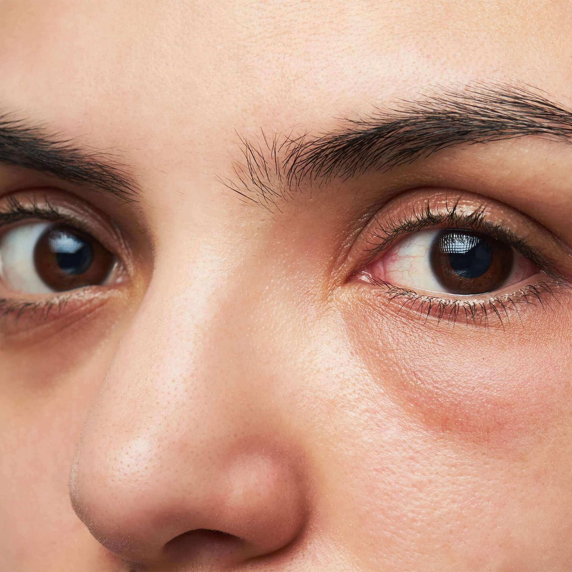 Understanding Dark Circles and Puffiness