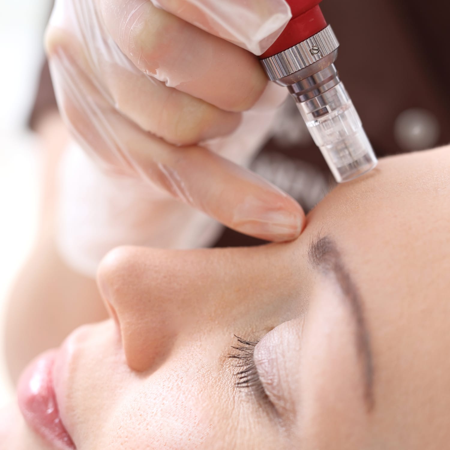 Benefici del Microneedling per le Cicatrici da Acne