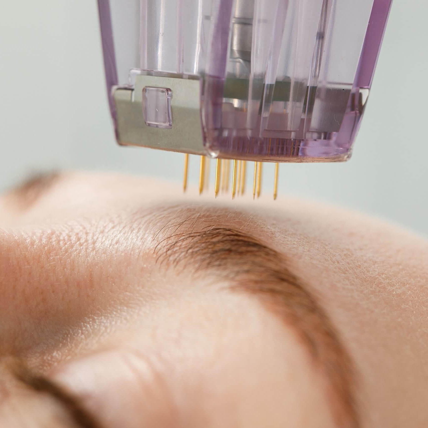 Cos'è il Microneedling?